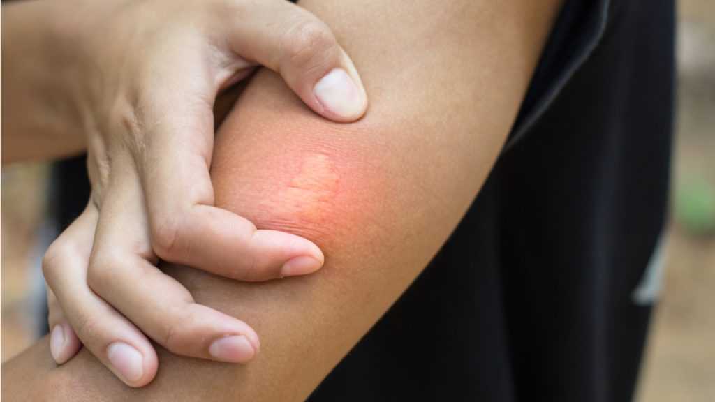 Bienenstich am Arm