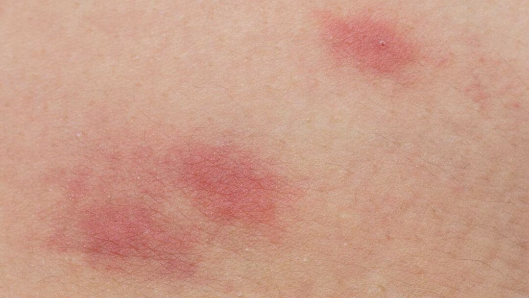 Wie sehen Flohbisse aus? Flohbisse bei Mensch und Haustier erkennen